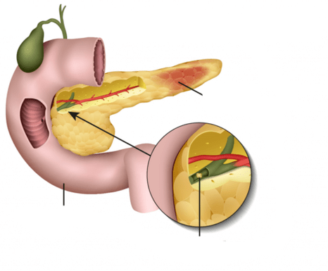 pancreatitis is een ontsteking van de alvleesklier